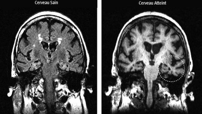 Découverte de onze nouveaux gènes favorisant Alzheimer